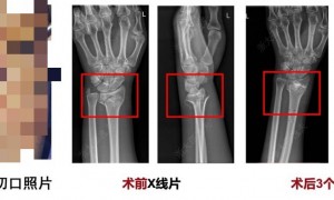 打一针就能治疗粉碎性骨折，浙大团队研发出全球首款“骨胶水”