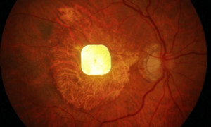 人类“芯片眼”来了?2毫米芯片植入眼球,失明老年人重见光明